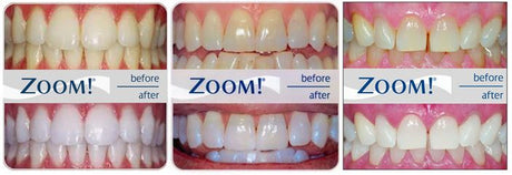 Philips ZOOM! Nite White Gel 16% CP + Mouth Trays, Case & Whitening Pen Philips ZOOM 